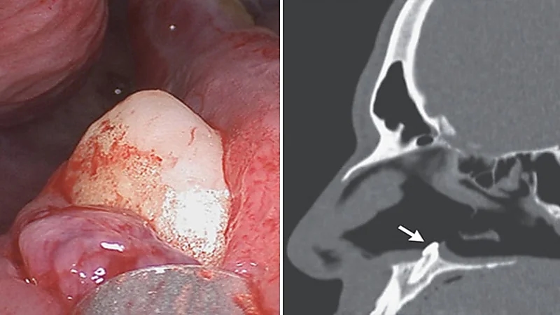 رجل يعاني من صعوبة التنفس بسبب نمو سن داخل أنفه