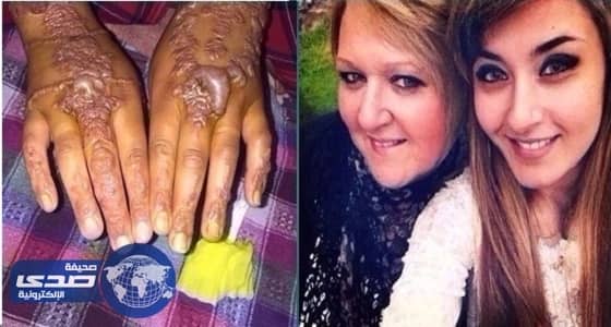 بالصور.. تشوهات نتيجة استخدم حناء سوداء بالمغرب