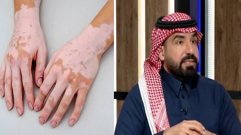 استشاري يكشف حقيقة العلاقة بين الصدمة النفسية والإصابة بالبهاق