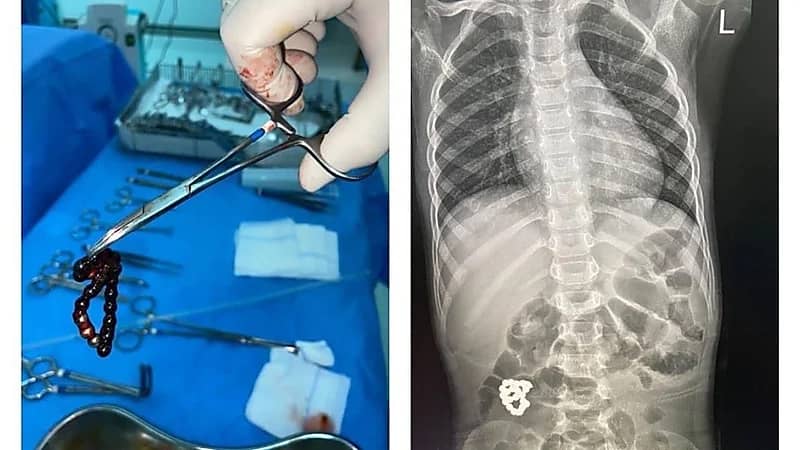 استخراج جسم غريب من أمعاء طفل في جدة 