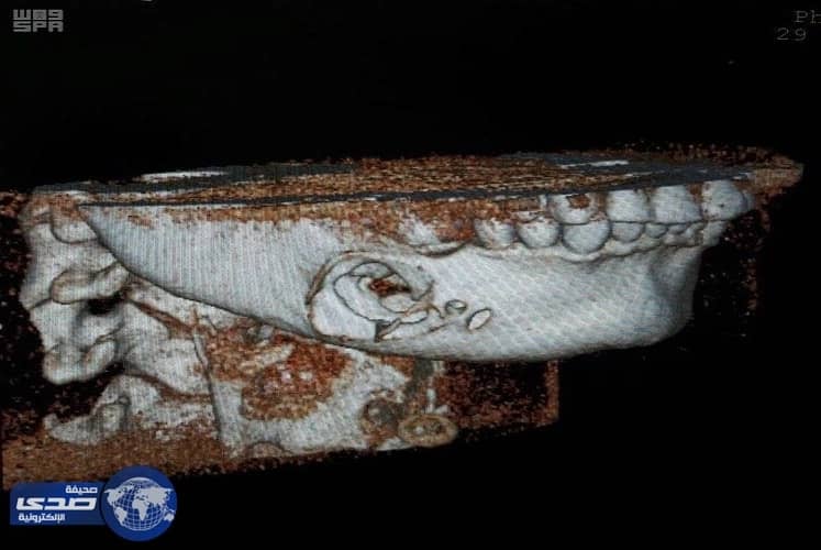 فريق طبي يزيل ورم بالفك لثلاثيني بمستشفى حفر الباطن المركزي