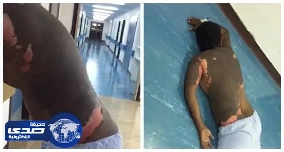 تدهور حالة الزوج المحروق بالزيت المغلي على يد زوجته بـ " بيشة "