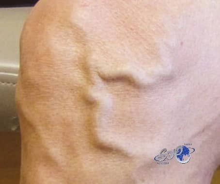 دوالي الساقين