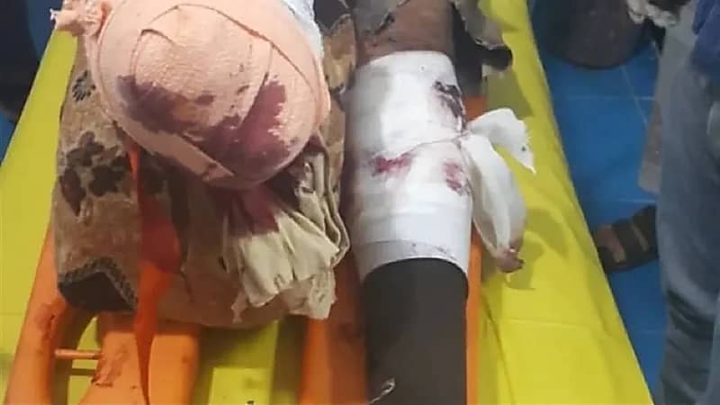 انفجار لغم حوثي يتسبب في إصابة مهندس بمشروع "مسام" السعودي