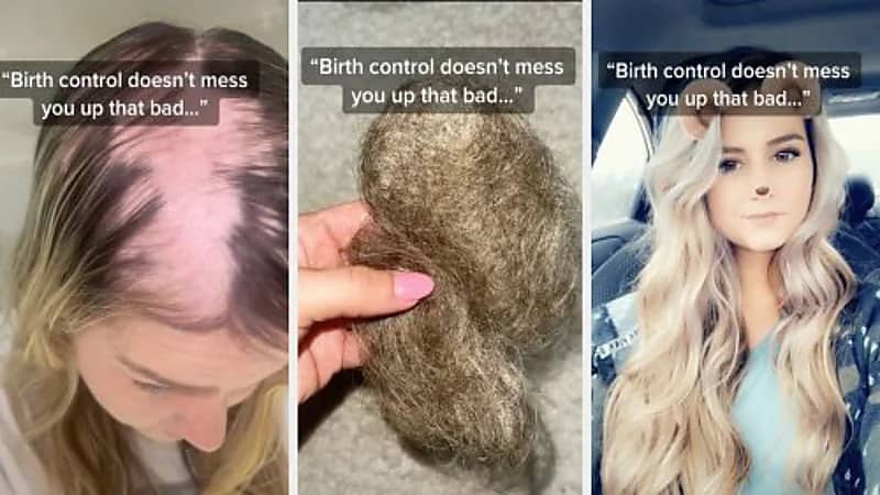 فتاة تفقد شعرها وتصاب بالصلع بسبب حبوب منع الحمل