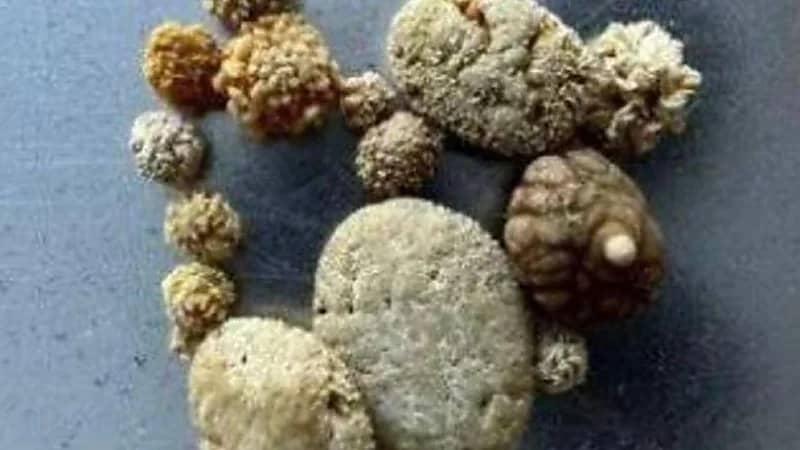 مخرج يعتبر حصوات كليته عملاً فنيًا ويعرضها للبيع