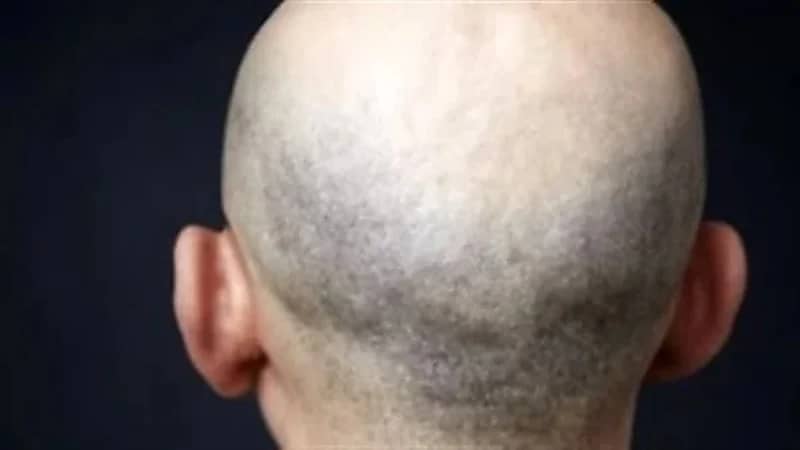 محكمة تعوض موظف بسبب طرده من وظيفته لأنه "أصلع"