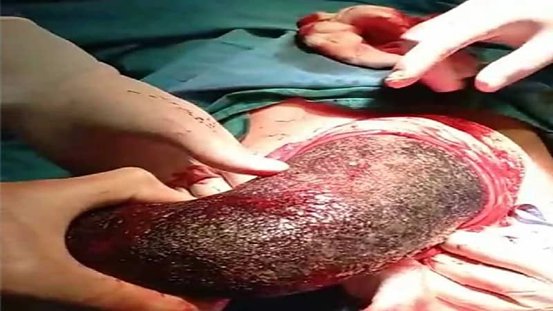 أطباء يسحبون كتلة شعر ضخمة من معدة فتاة