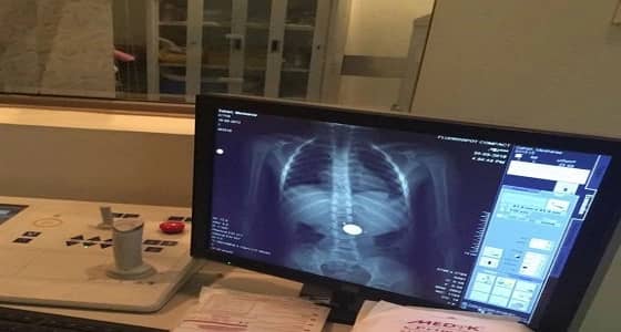 بالصور.. طفل يبتلع قطعة نقدية أثناء اللعب