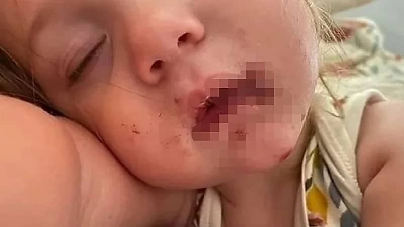 شاهد.. طفلة تتعرض لفيروس خطير بسبب قبلة