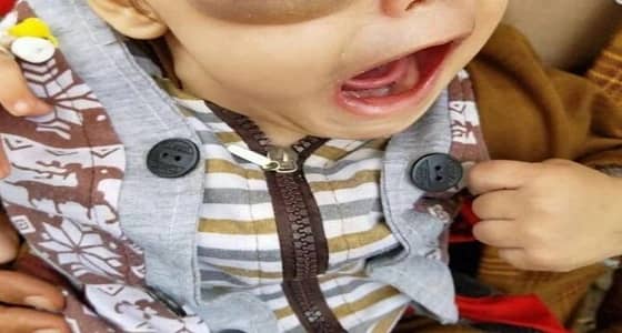 تطورات الحالة الصحية للطفل المصاب بورم الذي تكفل ولي العهد بعلاجه