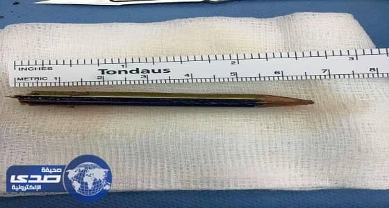 فريق طبي يستخرج قلم اخترق عين طفلة ووصل داخل المخ