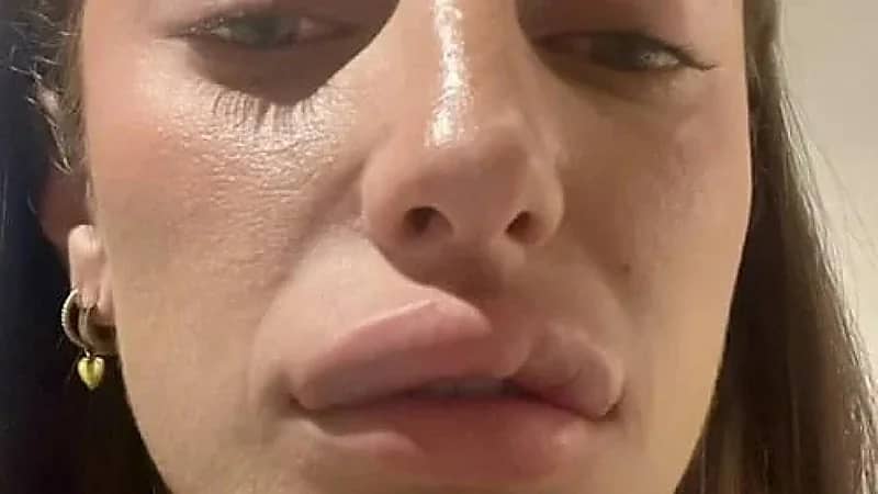 فتاة تشارك تجربتها المؤلمة مع إذابة الفيلر.. صور