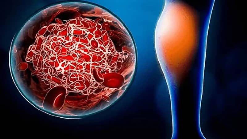 تعرف على علامات وأعراض جلطات الدم