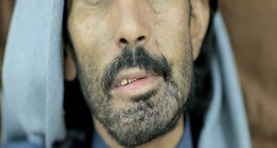 مريض يفقد النطق والقدرة على الطعام بسبب " إهمال طبي "