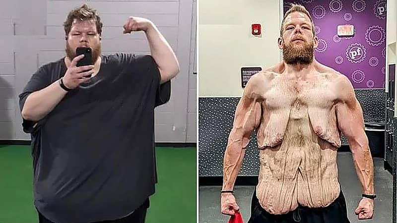 صورة صادمة لأمريكي خسر 152 كجم من وزنه