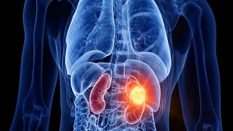 علامات تشير إلى الإصابة بـ "سرطان الكلى"