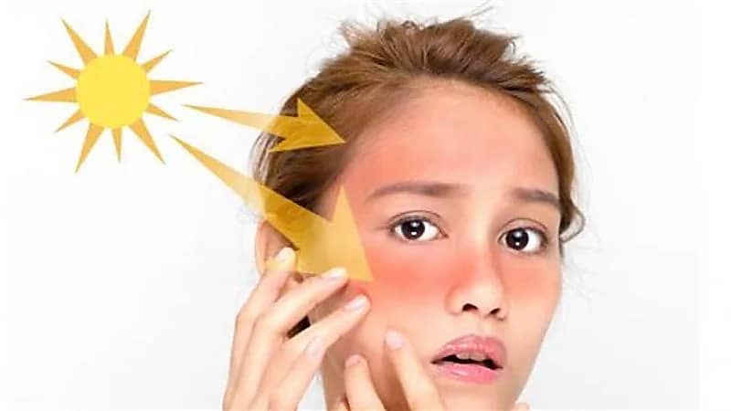 10 خطوات لعلاج حروق الشمس