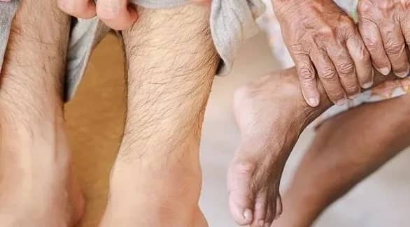 علامات تظهر على الساق تشير لارتفاع الكوليسترول