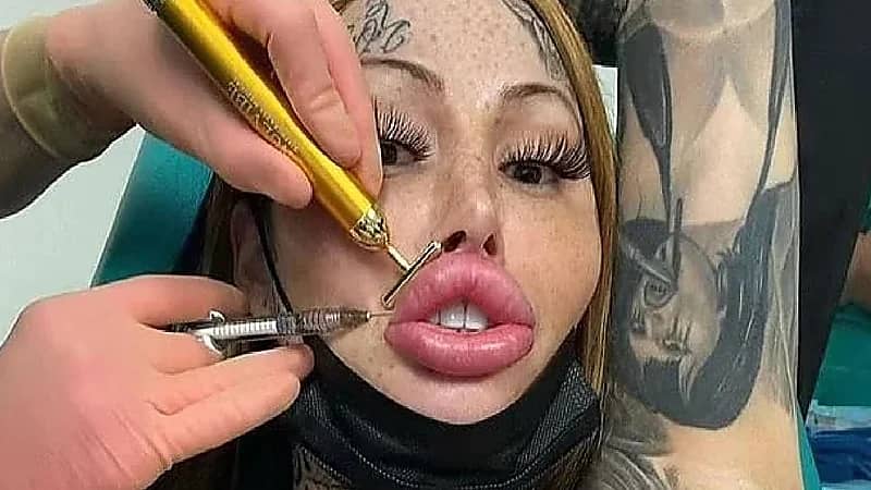 فتاة عشرينية تشوه وجهها وجسدها بعمليات التجميل