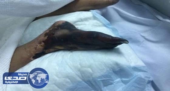 الإهمال الطبي في " الشميسي " يهدد قدم مواطنة بالبتر