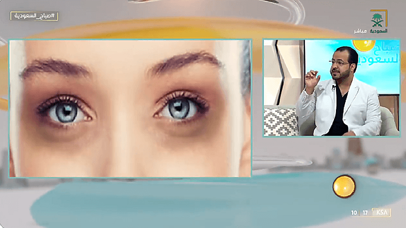 "استشاري" يوضح أسباب ظهور الهالات السوداء وكيفية القضاء عليها