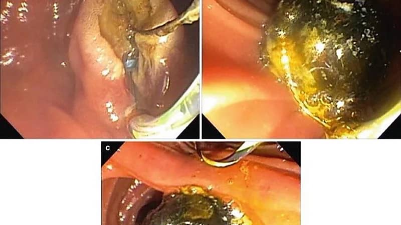 مختص: حصوات القنوات المرارية تُزال بالمنظار من الجسم