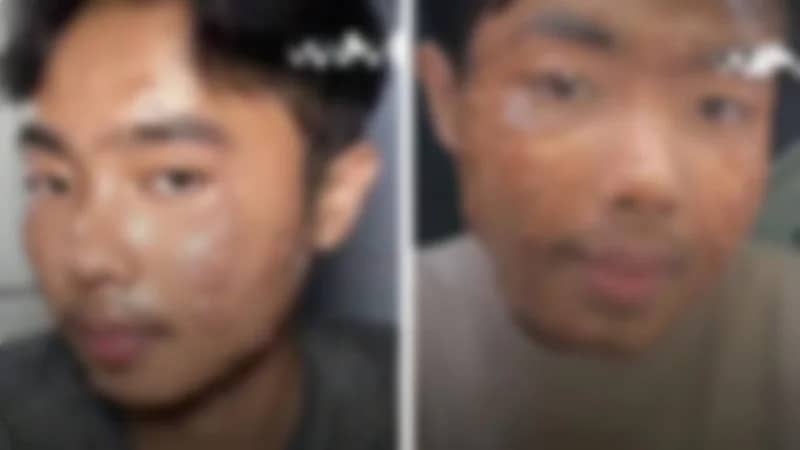 شاب يُصاب بعدوى جلدية بسبب الملابس المستعملة