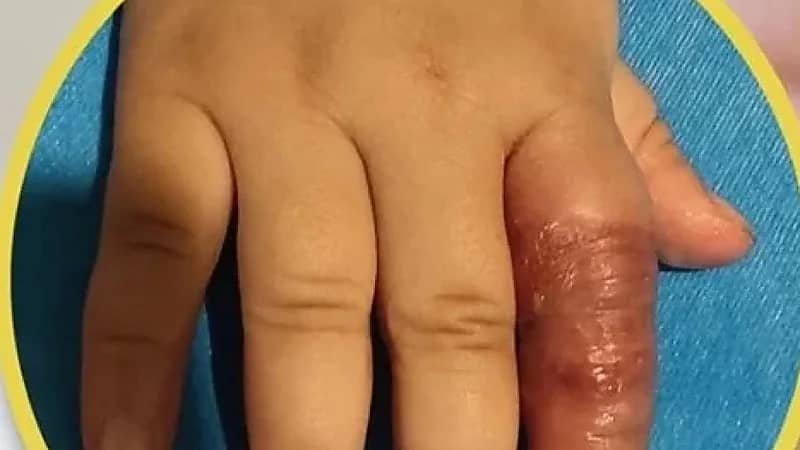 أم كادت تتسبب في بتر إصبع رضيعتها بسبب نصيحة على الانترنت