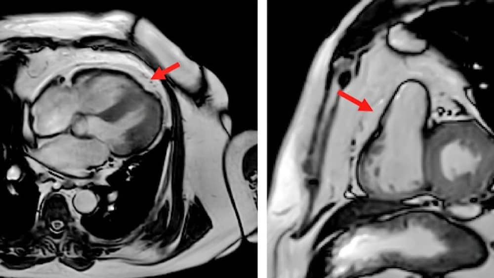 النمر : دهون القلب أخطر من دهون البطن ومنطقة الحوض