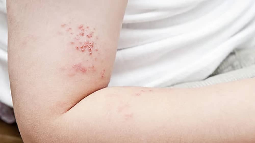 استشاري : أعراض ألم الحزام الناري أقوى على مرضى السكري .. فيديو