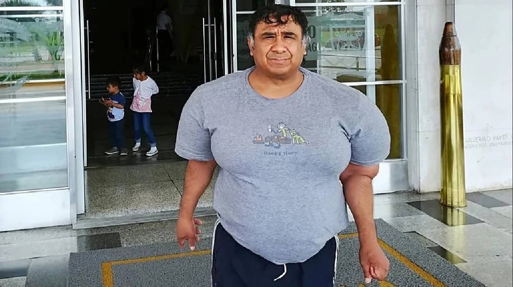 مرض نادر يجعل جسد رجل بيروفي كالبالون إثر حادث غوص.. صور