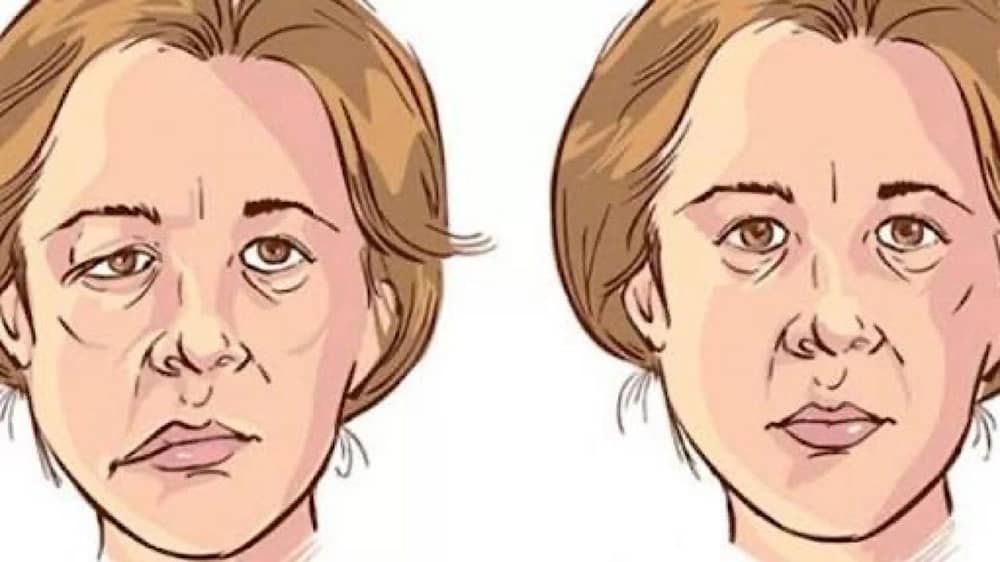 استشاري يوضح الفرق بين شلل العصب السابع والجلطة الدماغية .. فيديو