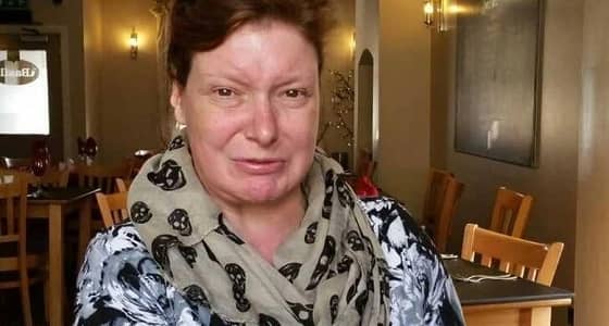 حالة نادرة تمنع سيدة من الابتسام  لأكثر من 30 عاما