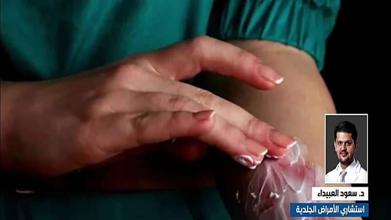 استشاري: استخدام الثلج وقت الحرق يوسع الإصابة ويتسبب بحروق باردة(فيديو)