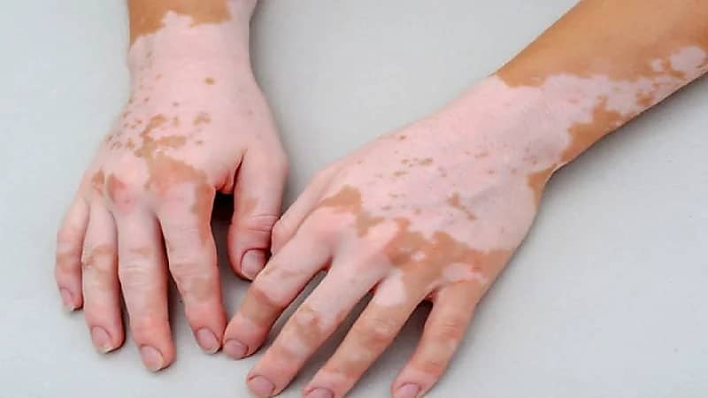 بالفيديو.. علاج موضعي يستخدم لأول مرة لمرض البهاق