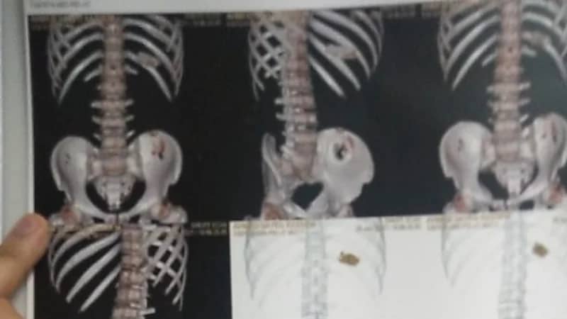 شاب يبتلع هاتفه المحمول 3 أشهر