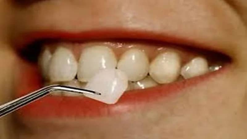 أخصائي يوضح كيفية الحفاظ على عدسات الأسنان "فيديو"