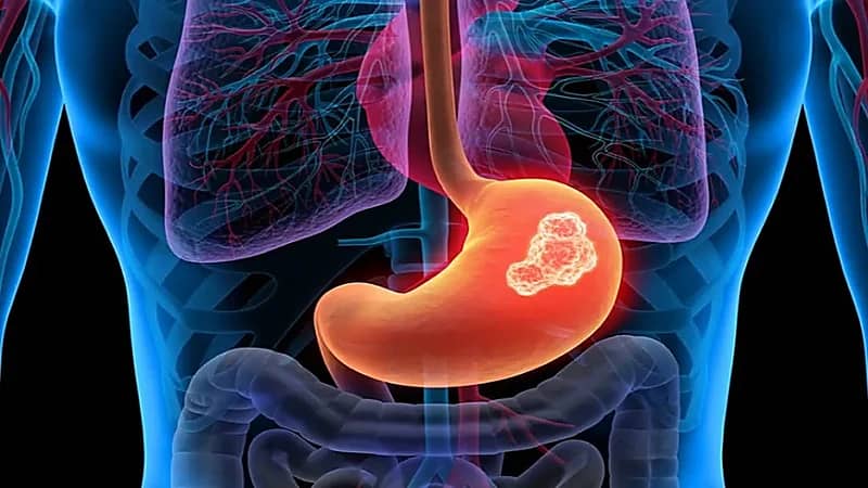ابتكار علاج ثوري للقضاء على سرطان المعدة