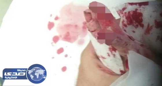 بالصور.. فئران تأكل فتاة مٌعاقة حية