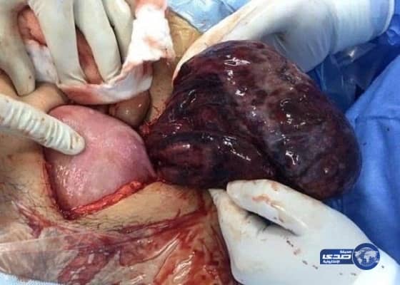 إنجاز طبي رابع خلال شهرين بمستشفي صبيا .. استئصال ورم وزنه ثلاثة كيلو من بطن سيدة