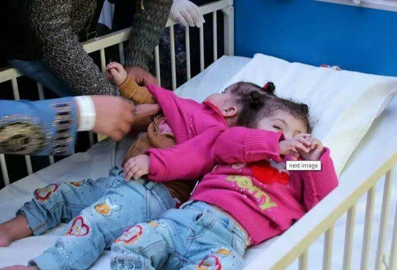 بالصور.. التوأم السيامي المصري "منة ومي "تصلان إلى مستشفى الحرس الوطني