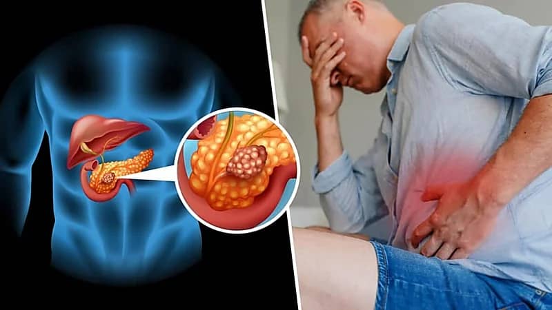 علامات تكشف احتمالية الإصابة بسرطان البنكرياس
