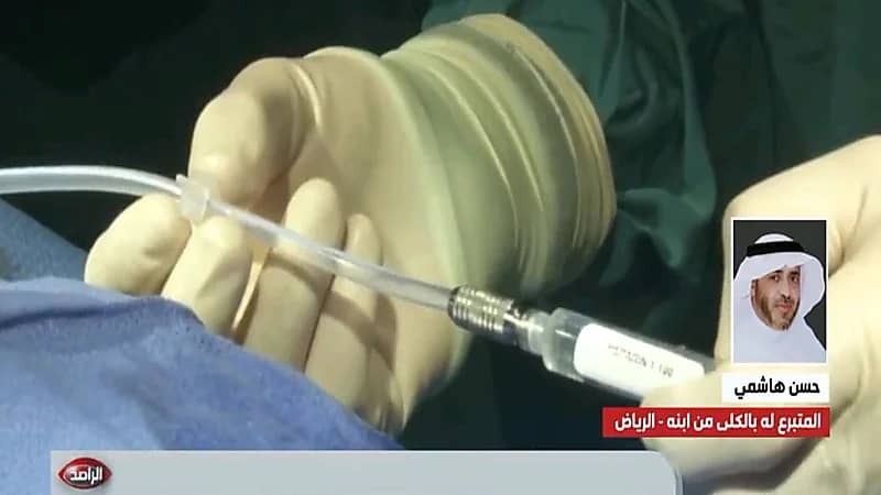 بالفيديو.. مواطن يروي قصة تسابق أبنائه على التبرع له بالكلى لإنهاء معاناته