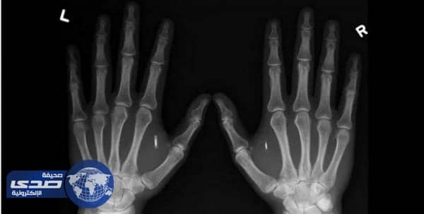 بالفيديو.. شركة تزرع رقاقات في أجساد موظفيها