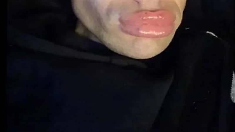 شاب ينفق 100 ألف دولار على عمليات تجميل باءت بالفشل