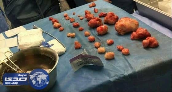 تخصصي تبوك ينهي معاناة سنوات لثلاثينية مع الأورام الليفية