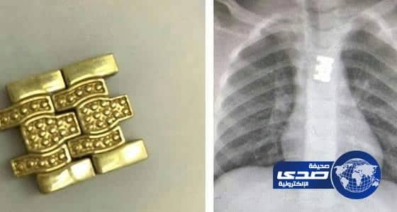 بالصور..مستشفى بريدة ينجح في استخراج قطعة "نُحاس" من مَرِيء طفلة