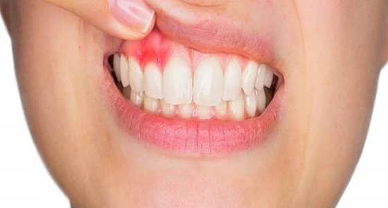 أمراض اللثة تزيد من خطر الإصابة بسرطان القولون بنسبة 80%