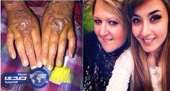 بالصور.. تشوهات نتيجة استخدم حناء سوداء بالمغرب